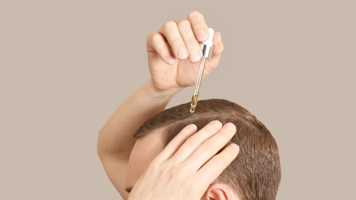 Cara Menghilangkan Ketombe Membandel Dengan 3 Minyak Ampuh, Anda Wajib Coba!